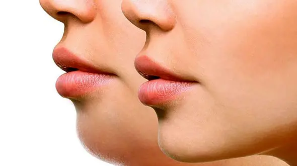 چگونه غبغب خود را کوچک کنیم؟ راهکارهای موثر