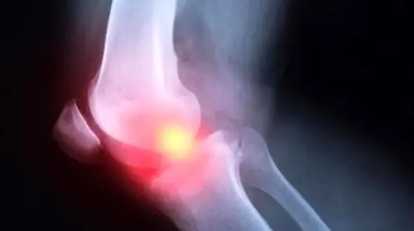 آرتروز جوانان؛ حقیقتی تلخ