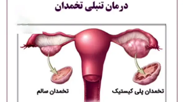 بهبود تنبلی تخمدان چگونه ممکن است؟