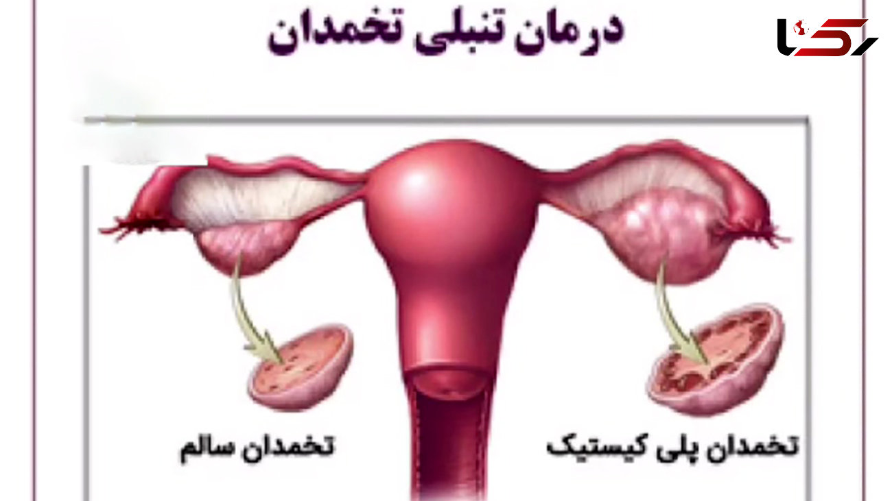 بهبود تنبلی تخمدان چگونه ممکن است؟