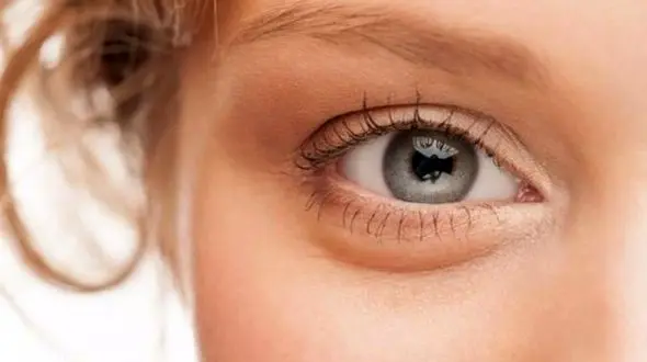 ارتباط پف زیرچشم با بیماری های کبدی