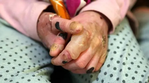 پانسمان مورد نیاز بیماران پروانه‌ای با پست ارسال می‌شود