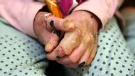 تکذیب مفقودی پانسمان بیماران پروانه‌ای از سوی وزارت بهداشت