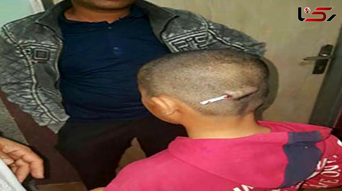 باز هم دانش آموزی شکنجه شد/فروکردن مداد بر سر دانش آموز رودباری توسط معلم + تصاویر 