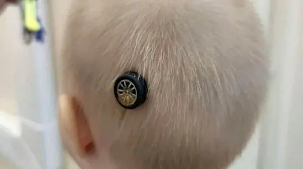  سوراخ شدن جمجمه یک کودک با اسباب بازی + عکس های هشدار دهنده