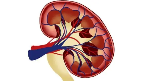 علائم سنگ کلیه و راه‌ های درمان آن؛ 5 باور اشتباهی که نباید باور کنید