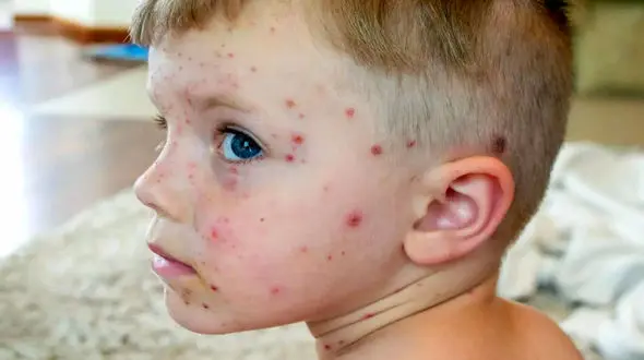 آبله مرغان چیست؟ / بهترین و بدترین غذاها در دوران آبله مرغان + فیلم