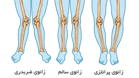 روش تشخیص پای پرانتزی و راه‌ های درمانی / فیلم