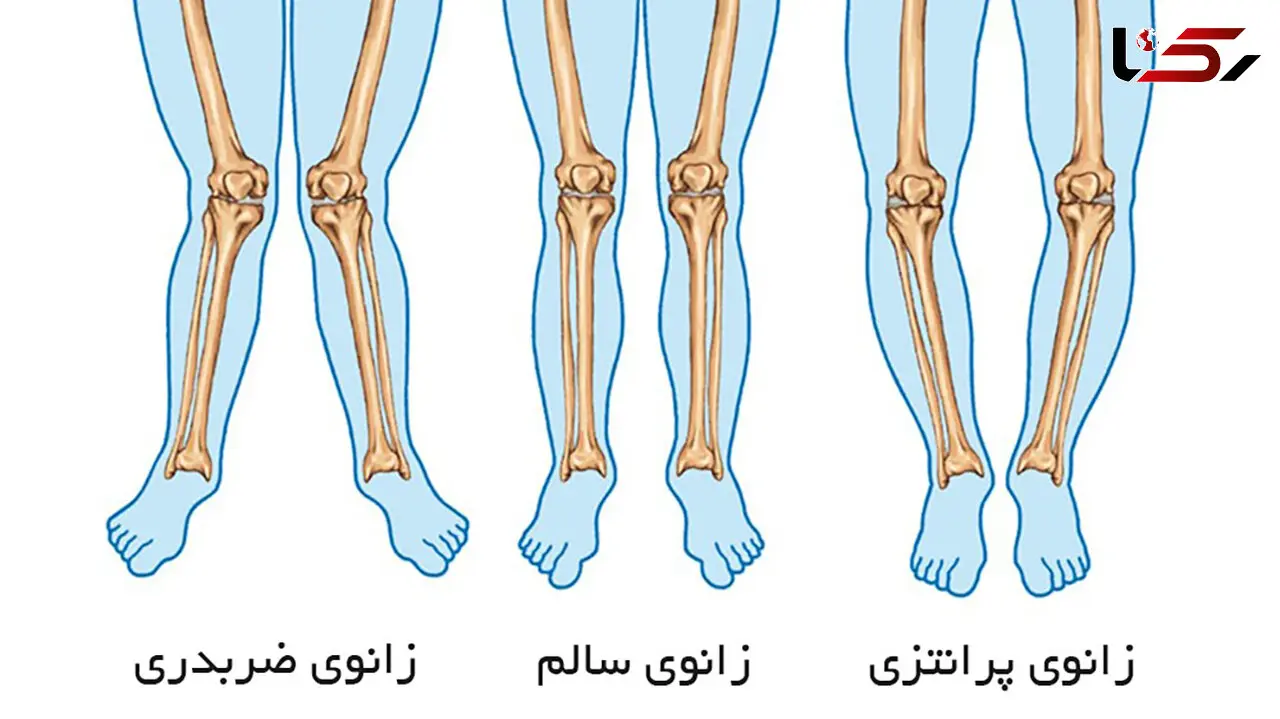 روش تشخیص پای پرانتزی و راه‌ های درمانی / فیلم