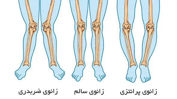 روش تشخیص پای پرانتزی و راه‌ های درمانی / فیلم