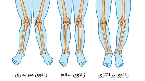 روش تشخیص پای پرانتزی و راه‌ های درمانی / فیلم