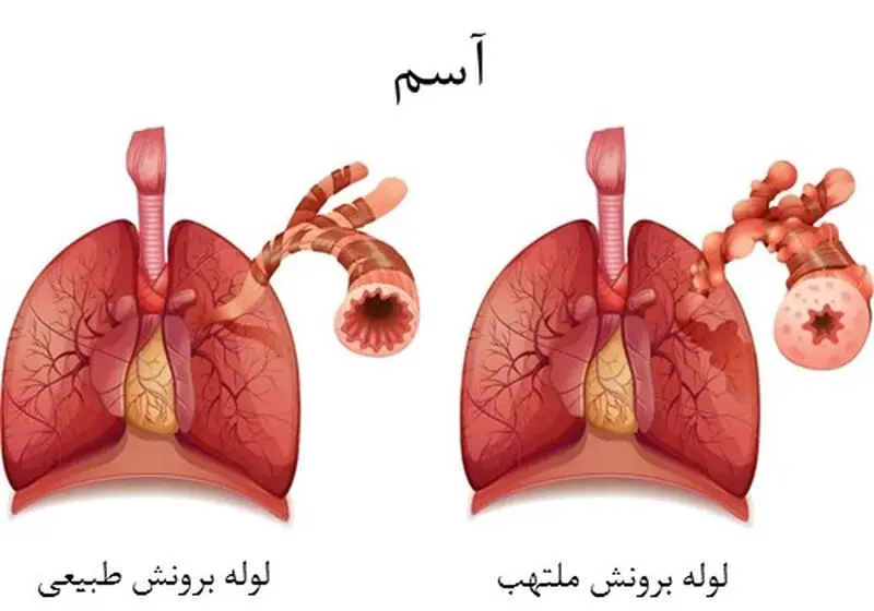 آسم