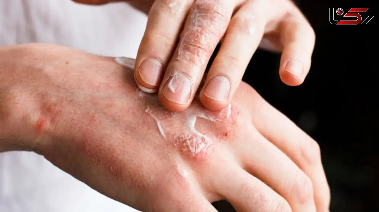 مقابله با  اگزما در هوای سرد