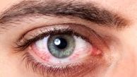 درمان خشکی چشم با این روش های موثر