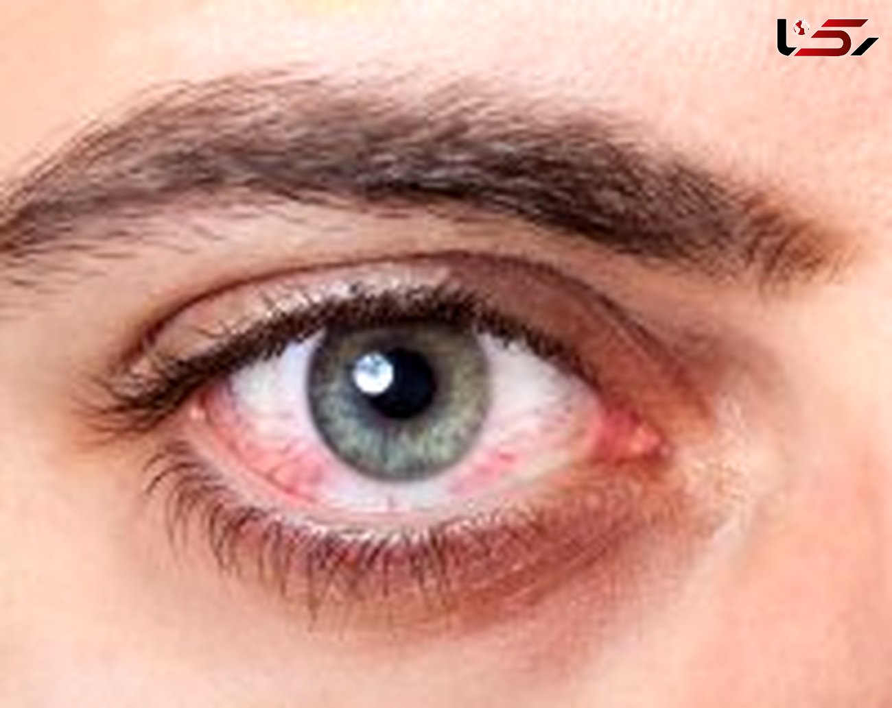 درمان خشکی چشم با این روش های موثر