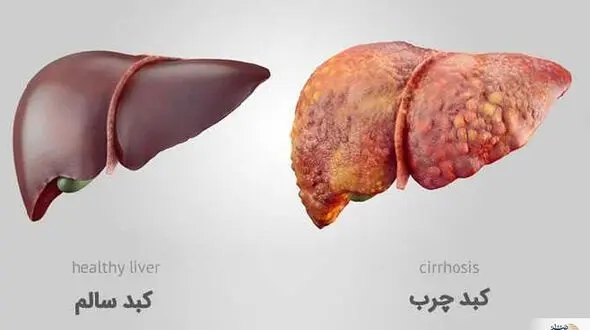 متخصص گوارش: کبد چرب و بسیاری بیماری‌های گوارشی اغلب بی‌علامت‌اند