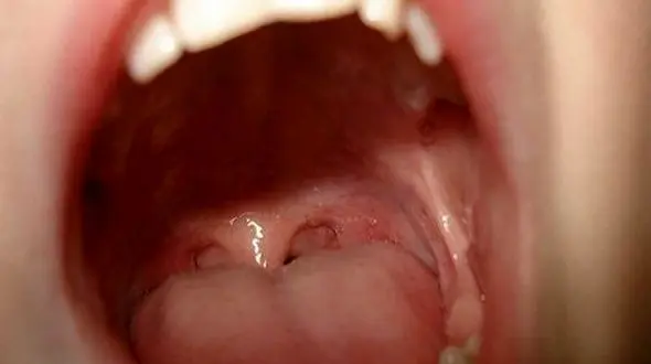 خلط چسبناک گلو نشانه چیست؟ + جدول 