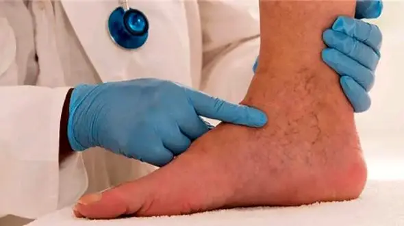 نشانه‌ های اولیه واریس که باید بدانید