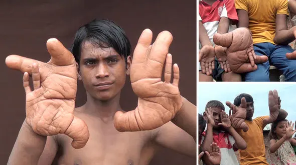 فرار از پسر نوجوان به خاطر داشتن دستان عجیب اش! عکس و فیلم