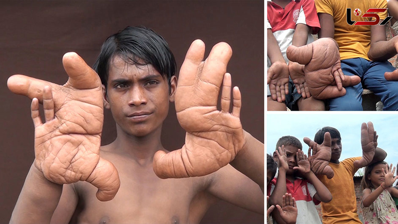 فرار از پسر نوجوان به خاطر داشتن دستان عجیب اش! عکس و فیلم