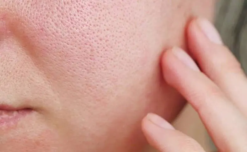 treatment-of-oily-skin-with-open-pores