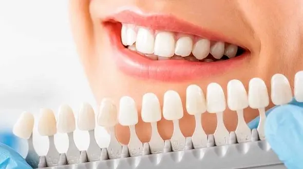 بلیچینگ دندان چیست؟  + شرایط برای بلیچینگ دندان