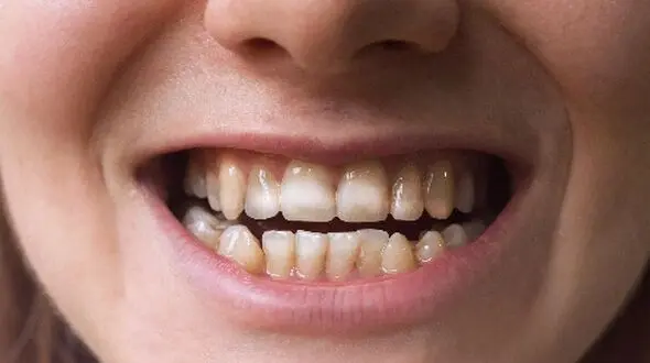 پاکسازی لکه‌های قهوه‌ای دندان با 7 راه ساده و خانگی