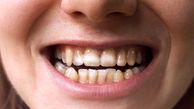 پاکسازی لکه‌های قهوه‌ای دندان با 7 راه ساده و خانگی