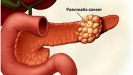 عوامل موثر در بروز سرطان پانکراس/علائم این سرطان کشنده را بشناسید