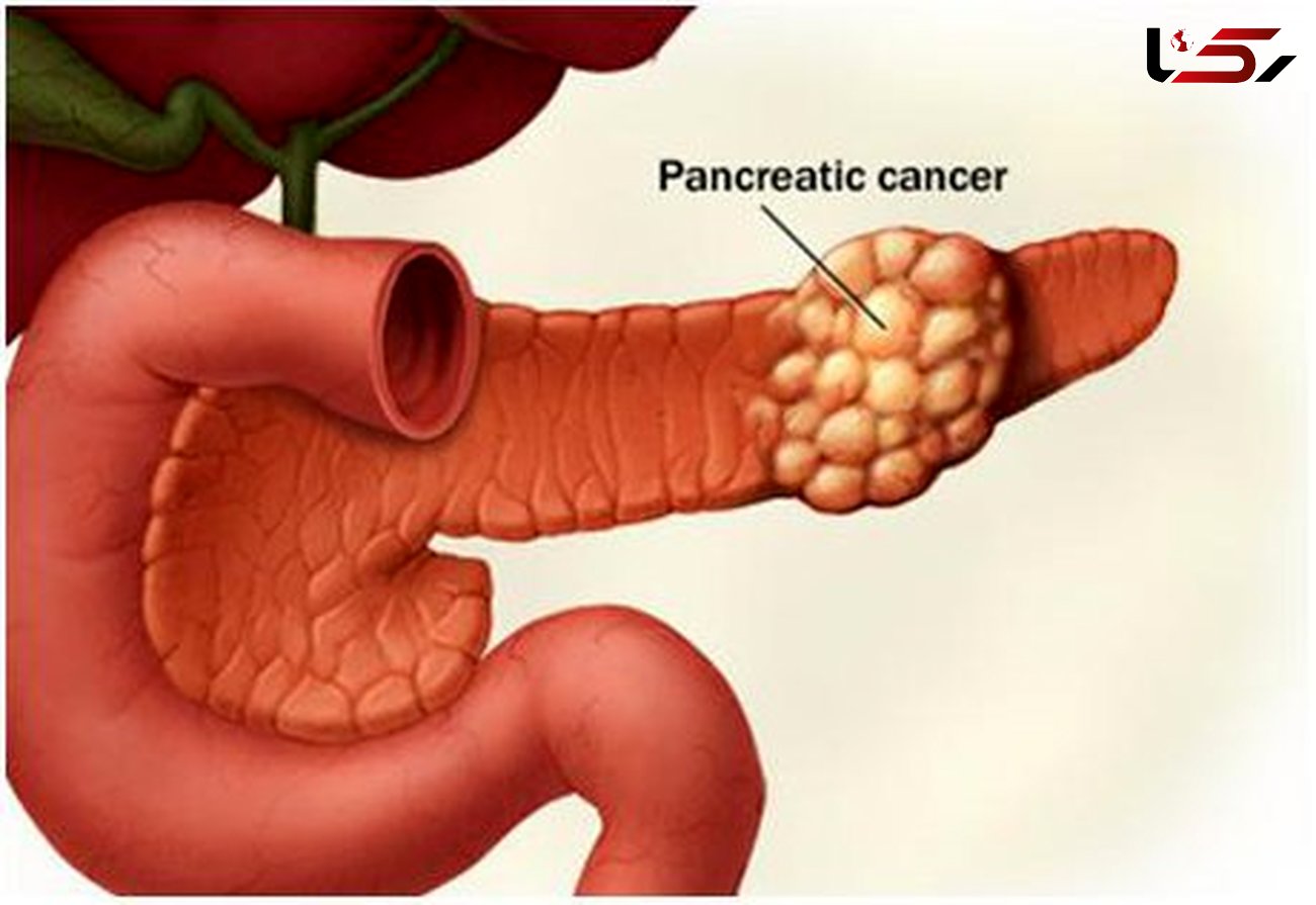 عوامل موثر در بروز سرطان پانکراس/علائم این سرطان کشنده را بشناسید