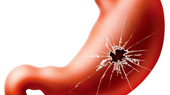 همه چیز درباره زخم معده