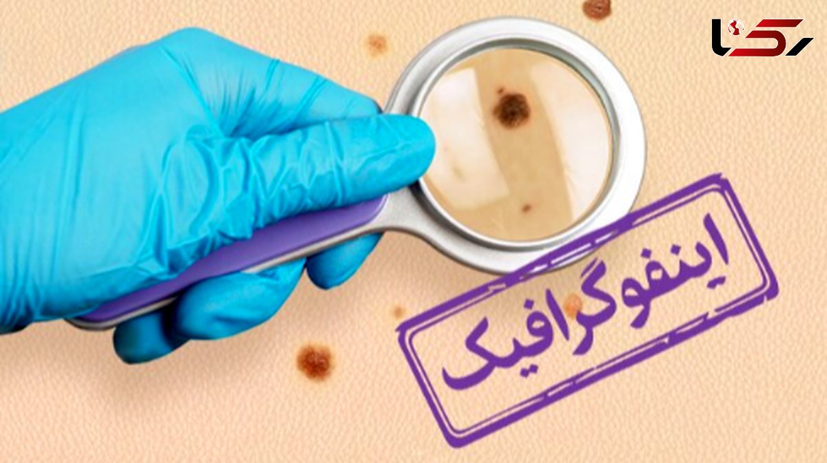 اینفوگرافیک: چگونه سرطان‌ های شایع در کشور را به موقع تشخیص دهیم؟