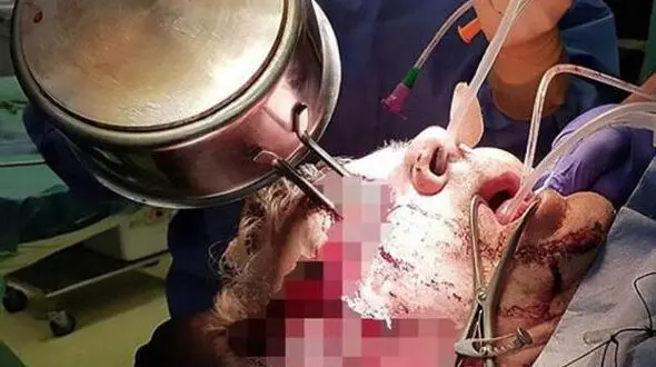 دسته ماهی تابه داخل چشم آشپز فرو رفت! + تصاویر باور نکردنی