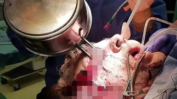 دسته ماهی تابه داخل چشم آشپز فرو رفت! + تصاویر باور نکردنی