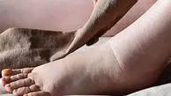 هشدار / تورم ناگهانی پا نشانه جدی بیماری ترومبوز ورید عمقی