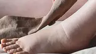 هشدار / تورم ناگهانی پا نشانه جدی بیماری ترومبوز ورید عمقی