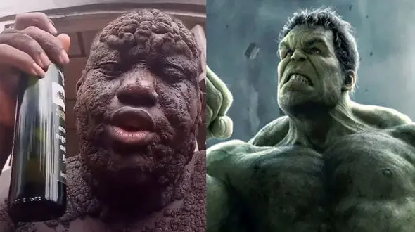 این مرد زشت ترین هیولای جهان شد / فیلم چهره ای که باور نمی کنید!