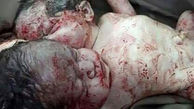 عجیب و وحشتناک / تولد نوزاد دختر افغان با 2 سر و یک بدن / دکتر عارف جلالی خبر داد+ عکس