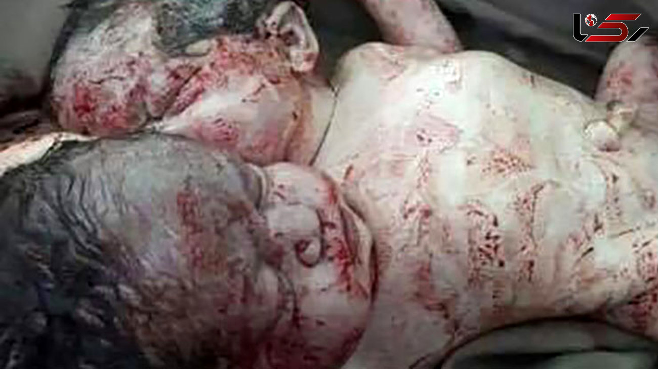 عجیب و وحشتناک / تولد نوزاد دختر افغان با 2 سر و یک بدن / دکتر عارف جلالی خبر داد+ عکس