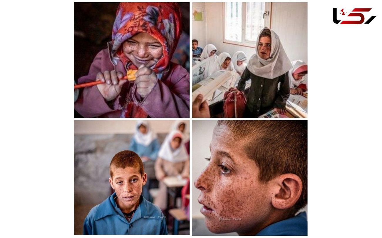 آقای وزیر بهداشت کودکان "لجنگ"به کمک پزشکی نیاز دارند/ تکرار گزارش از درگیری اهالی روستا با بیماری پوستی خطرناک