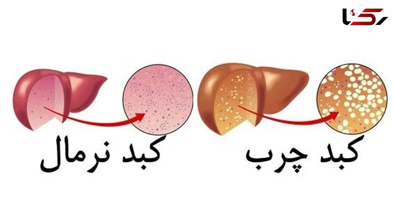 تاثیر وزن هنگام تولد بر ابتلا به بیماری کبد چرب 