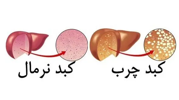 تاثیر وزن هنگام تولد بر ابتلا به بیماری کبد چرب 