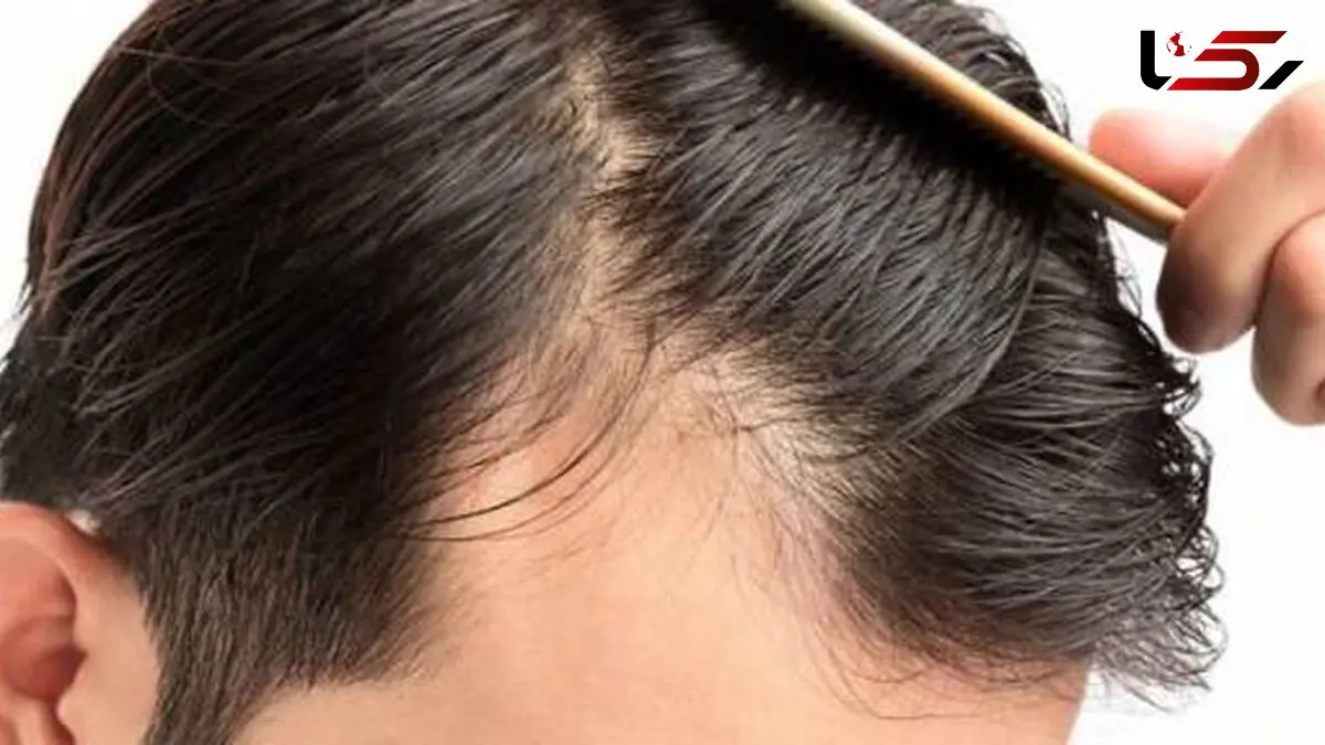 4 دلیل شایع ریزش مو در جوانی