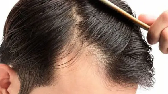 4 دلیل شایع ریزش مو در جوانی