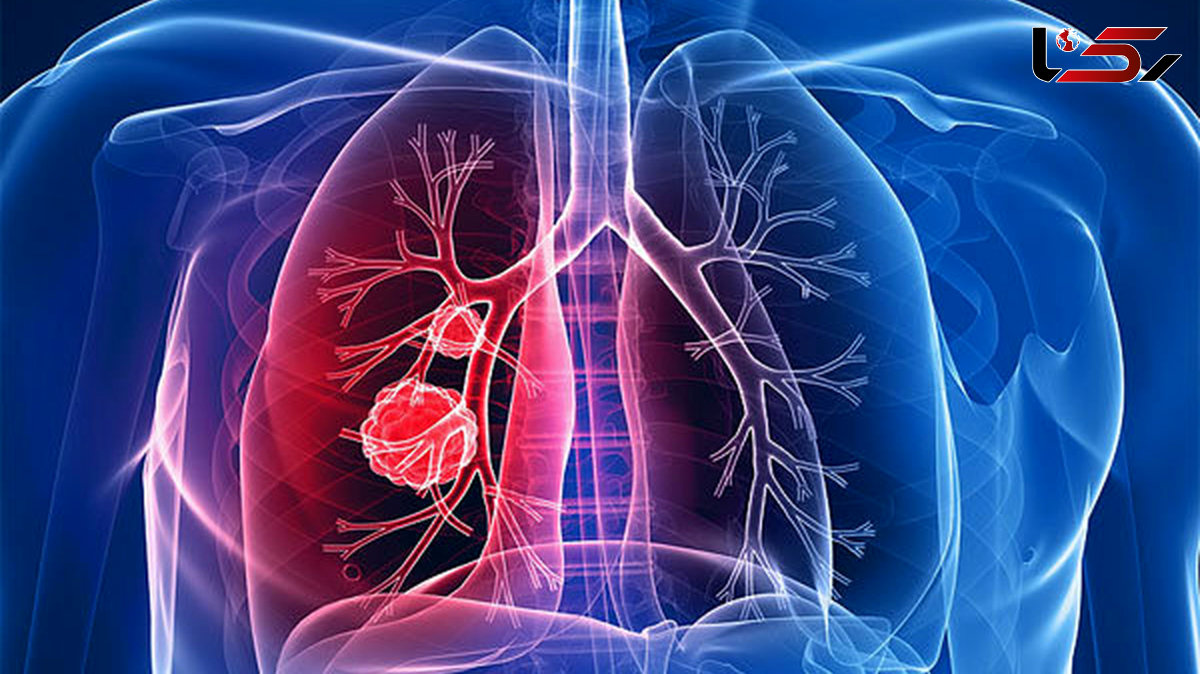 عجیب و مهم ترین علامت سرطان ریه 