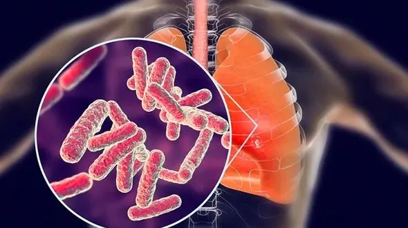  اتباع غیرمجاز؛ مهم ترین عامل افزایش سل در ایران
