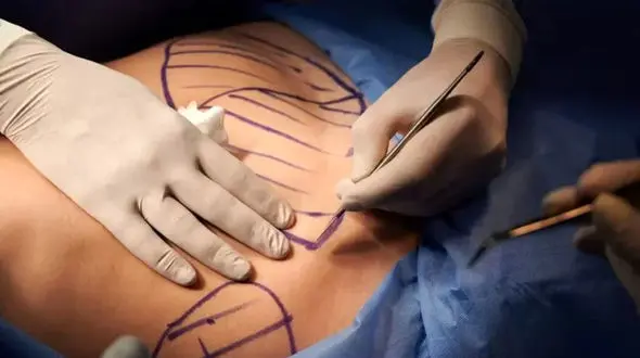 عمل لیپو ابدو چیست؟ + بهترین روش جراحی زیبایی فرم دهی به شکم