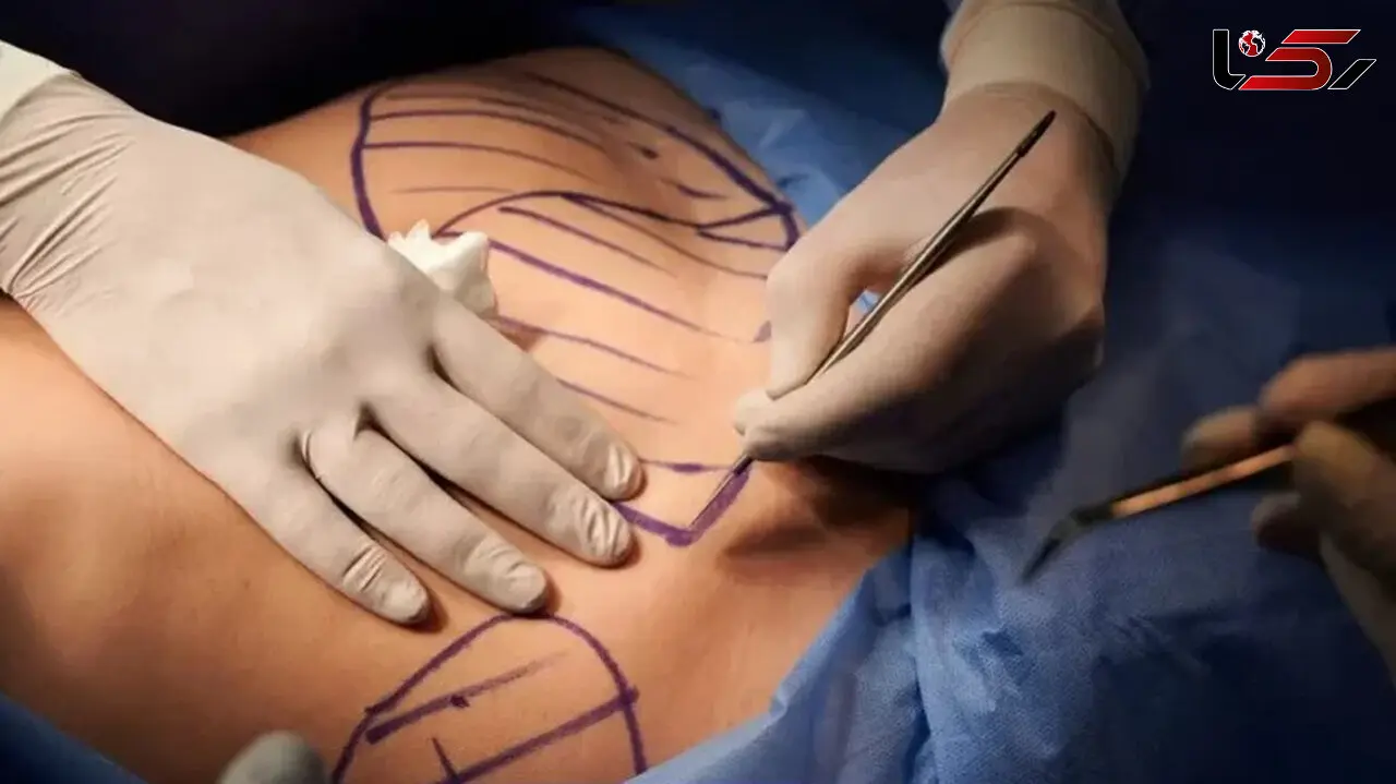 عمل لیپو ابدو چیست؟ + بهترین روش جراحی زیبایی فرم دهی به شکم