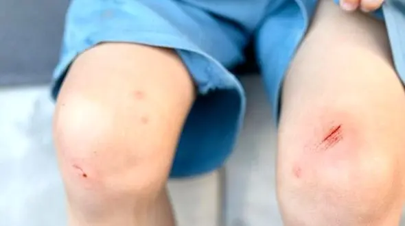 چه زمانی یک کبودی ساده می‌تواند به خطر تبدیل شود؟