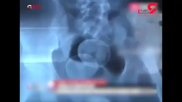 پسر 14 ساله از سال 2016 شروع به تخم‌گذاری کرد!+ فیلم